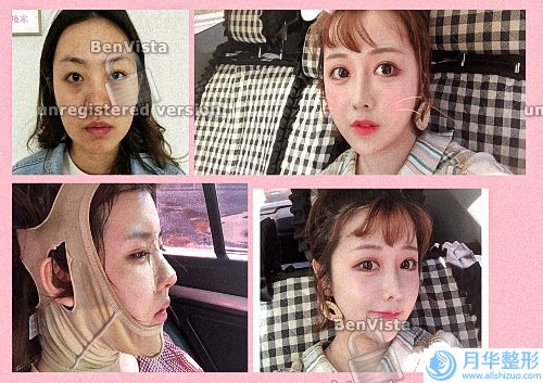 額頭填完了脂肪可以再填玻尿酸嗎_玻尿酸額頭幾天能平整