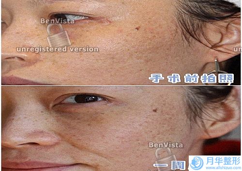 注射鐳射溶脂瘦臉對(duì)身子影響大嗎