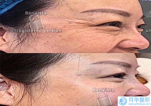 “較好”玻尿酸，你了解多少？不同價格玻尿酸有什么區(qū)別呢？(為什么有的人年紀(jì)輕輕皺紋卻不少？真相就是這三個！)