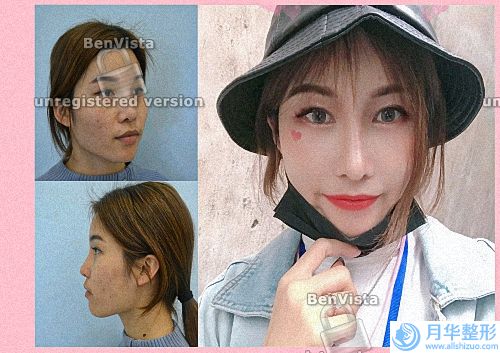 接種新冠對整形有什么影響？美容整形新冠疫苗醫(yī)學(xué)(整形會遇到什么奇葩事？日常面診奇葩奇葩奇葩)