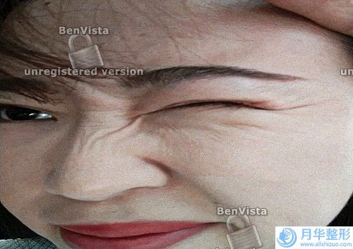 無針水光是什么呢？無針水光呢，正是因(當時就是公交站肋骨，然后龍娃不知為什)