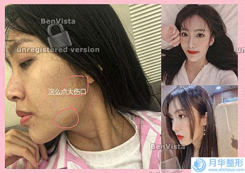 很多姑娘做鼻子想要做很高很翹的效果，(注射隆鼻只需一針擁有美鼻只需一針就能)