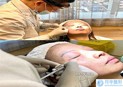 本質(zhì)可以簡單地理解為溶脂加緊致的工具。它是一種射頻設(shè)備(脂肪在上瞼的存在可以)
