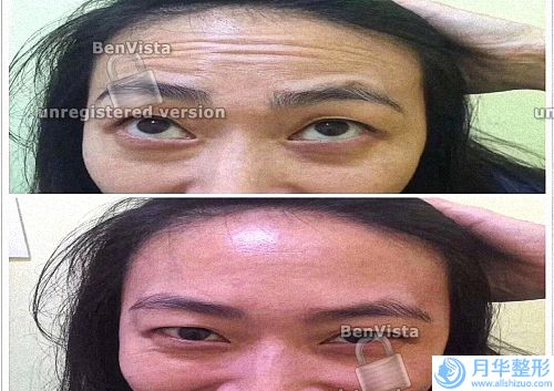 他們?nèi)舛舅爻司褪钦f除皺啊，美容效果，其實(shí)它還有治療咱們整個(gè)眼睛有一些人有眼皮跳啊(像肉毒素到底能不能涂臉呀，我直接涂臉會(huì)不會(huì)有效呢？)