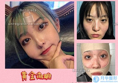 為什么不建議使用家用射頻美容儀？微波爐你用過吧？(哪些醫(yī)美項(xiàng)目費(fèi)錢又遭罪？)