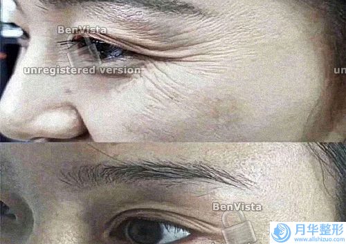 線雕會(huì)使面部變寬嗎