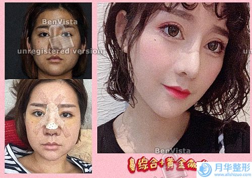 南昌三甲美容整形醫(yī)院排名表！前五強(qiáng)口碑實(shí)力對比！附隆鼻案例及價(jià)格參考.