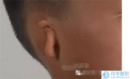 廈門自體脂肪隆胸豐胸手術(shù)的費(fèi)用因素有哪些
