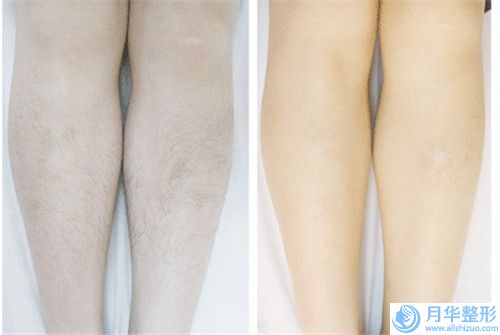滄州肉毒素治療面肌痙攣美容費(fèi)用花多少