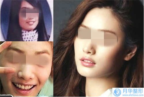 侯中華整形醫(yī)生-德州天宏醫(yī)療美容門診部侯中華醫(yī)生微晶瓷墊下巴霸榜前3