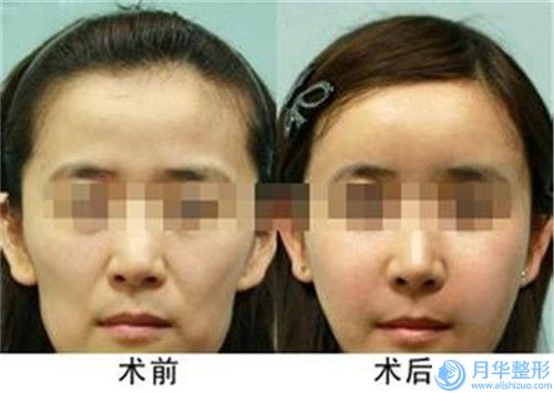 亳州市兔唇兔唇手術(shù)價格表火熱一覽(10月-4月兔唇兔唇手術(shù)均價為：68087元)