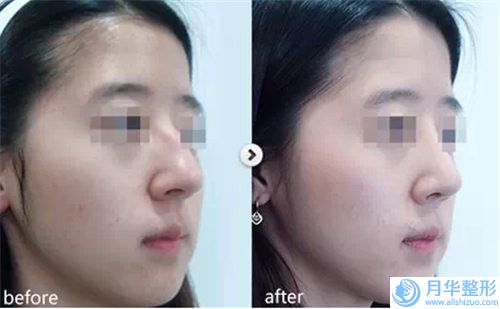 海南省玻尿酸隆鼻整形醫(yī)生榜單前十強(qiáng)匯合-海南省邱加恩整形醫(yī)生