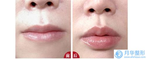 呼和浩特脂肪填充下巴當(dāng)天的價(jià)格是多少與哪些因素有關(guān)