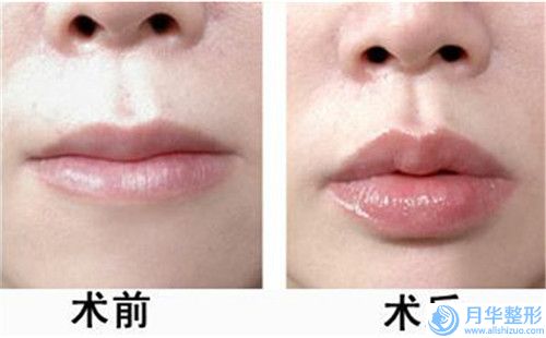 齊齊哈爾市自身脂肪豐下巴2023價格表（費用）內(nèi)部流出-齊齊哈爾市自身脂肪豐下巴價格需要花多少