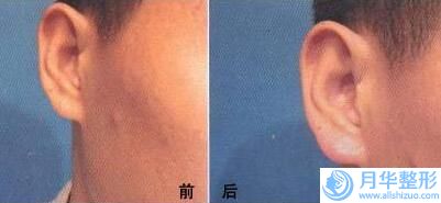 佛山手術(shù)法豐胸的價(jià)格便宜嗎效果明顯嗎
