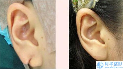 煙臺乳房下垂提升手術(shù)整容手術(shù)價錢是多少
