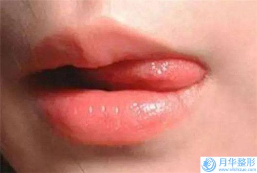 洛陽雙下巴抽脂術(shù)的價格是需要多少,洛陽雙下巴抽脂術(shù)美容的價格高不高
