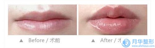 自體脂肪豐下巴填充存在的風(fēng)險大嗎(自體脂肪豐下巴填充手術(shù)有風(fēng)險么)