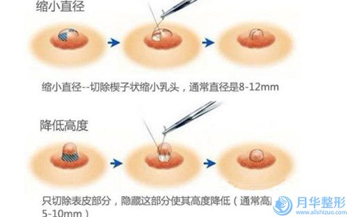 深圳市玻尿酸填充豐額頭2023新版【價格表】官方拔草-均價玻尿酸填充豐額頭15045元