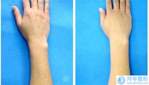 去掉臉上色斑要多少錢哪家醫(yī)院效果好