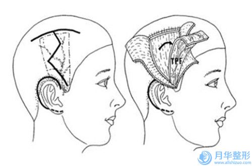 雙環(huán)法乳房下垂手術(shù)是否有后遺癥,雙環(huán)法乳房下垂可能會(huì)存在哪些后遺癥