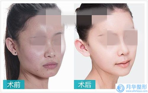 遵義鼻頭變小手術(shù)的費(fèi)用及注意事項(xiàng)(遵義鼻頭變小手術(shù)的費(fèi)用怎么算)