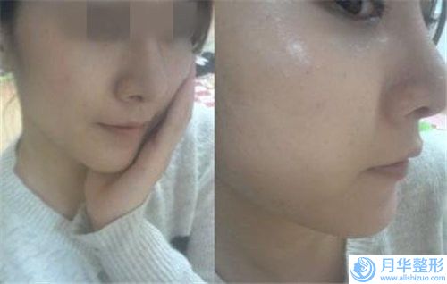 婁底市MISKO4D隆鼻爆款價(jià)格表正式發(fā)布-均價(jià)MISKO4D隆鼻27019元