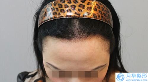 南通微整形注射瘦臉手術(shù)價(jià)格以及注意事項(xiàng)
