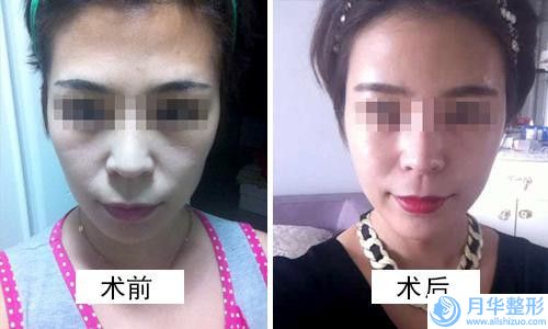 鄭州市做修復(fù)兔唇價(jià)格表全新完整曝出-鄭州市做修復(fù)兔唇后修復(fù)費(fèi)用