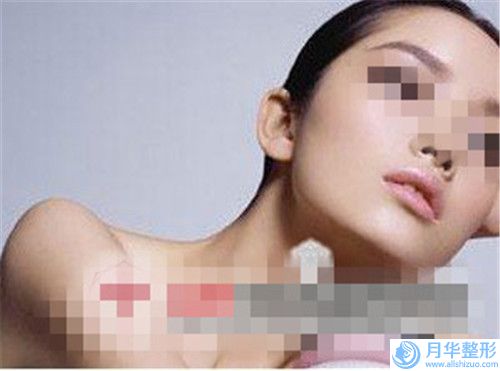 手術(shù)去副乳整形大概需要費用是多少錢啊