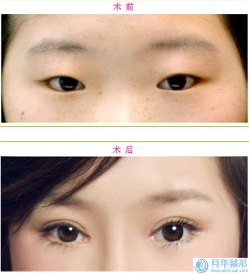 鎮(zhèn)江三點(diǎn)法雙眼皮價(jià)格和注意事項(xiàng),鎮(zhèn)江三點(diǎn)法雙眼皮術(shù)所有費(fèi)用多少錢(qián)