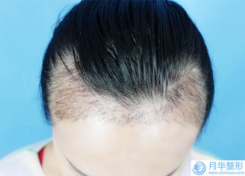 北京注射肉毒桿菌瘦臉整容費(fèi)用是多少