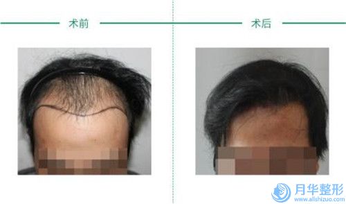 南寧伊維蘭注射豐臉頰的價格及影響因素