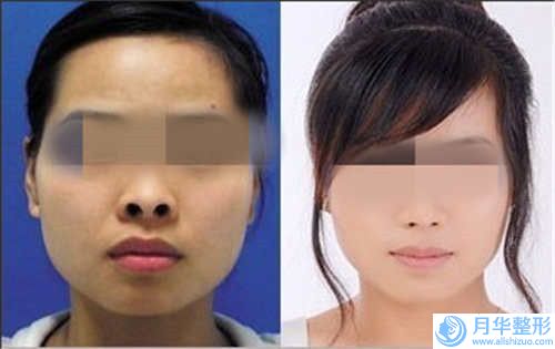 玻尿酸豐下巴整形手術(shù)多久后可以看到效果