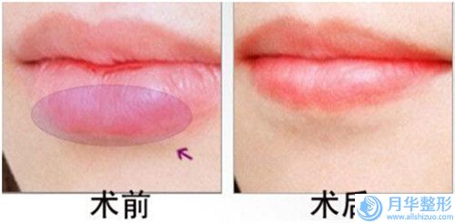 自體脂肪隆下巴治療后效果如何-自體脂肪隆下巴手術(shù)優(yōu)勢多多效果好