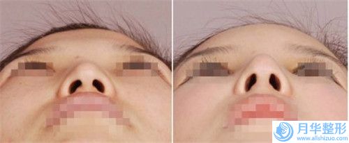 合肥針灸拔罐治療減肥所需的價格_合肥針灸拔罐治療減肥手術(shù)的價格一般要多少