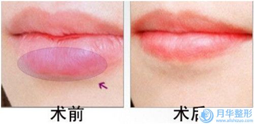 遂寧市雙下巴吸脂費用標(biāo)準(zhǔn)展示(近6個月均價為：3286元)