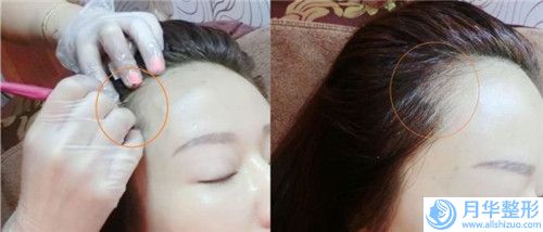 溫州botox瘦臉針圖手術(shù)多少錢效果如何