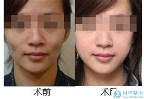 濰坊市唇裂的價(jià)格費(fèi)用查詢(2023年5月均價(jià)為：34219元）