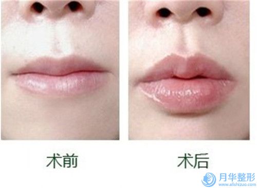 湛江隆下巴注射手術價格高不高呢_湛江隆下巴注射美容價格一般是多少