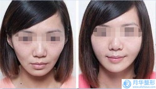牡丹江市成人唇裂二期修復(fù)手術(shù)熱門價(jià)格表完整出爐-牡丹江市成人唇裂二期修復(fù)手術(shù)價(jià)格行情