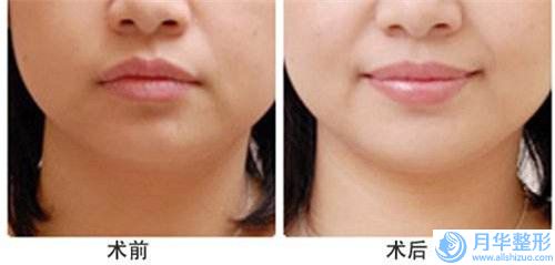 上海下巴吸脂優(yōu)勢手術便宜的醫(yī)院是哪家