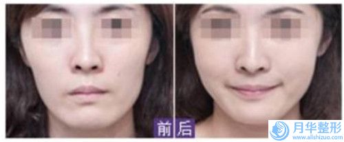 南京伊而菲斯醫(yī)療美容門診部整形價格分享-南京伊而菲斯醫(yī)療美容門診部唇裂術(shù)手術(shù)一般需要費(fèi)用是多少