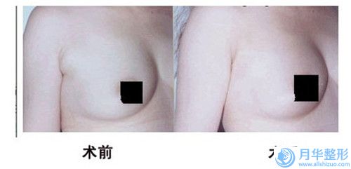 呼和浩特回民區(qū)張高貴醫(yī)療美容門診部本院全新價格表-自體脂肪顆粒注射額部填充術(shù)32524-62433元