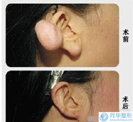 撫順自體脂肪豐胸手術(shù)手術(shù)的費(fèi)用大致是多少