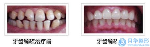馬鞍山肚子抽脂美容費(fèi)用多少-馬鞍山肚子抽脂價(jià)格因素是什么