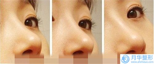 石家莊自體軟骨隆鼻費(fèi)用昂貴嗎「石家莊自體軟骨隆鼻術(shù)價(jià)格是由什么決定的」