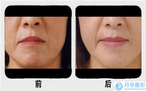 山東濟南海峽美容整形醫(yī)院做下巴整形咋整形費用是多少