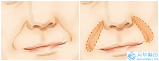 遂寧激光去剖腹產(chǎn)疤痕矯正有危險嗎