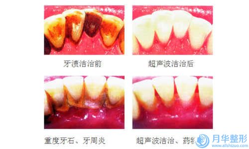 石家莊市射頻溶脂背部塑形價(jià)格表(費(fèi)用)隆重發(fā)布(射頻溶脂背部塑形均價(jià)為：5606元）